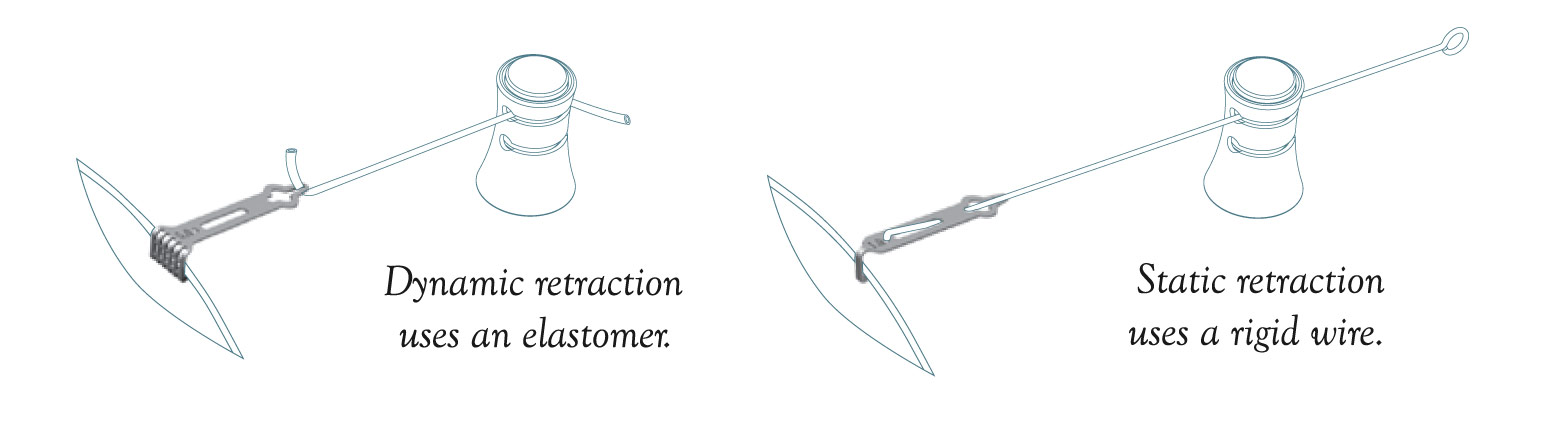 Dynamic retraction vs static retraction