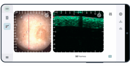 skin-imaging-dermus-skinscanner