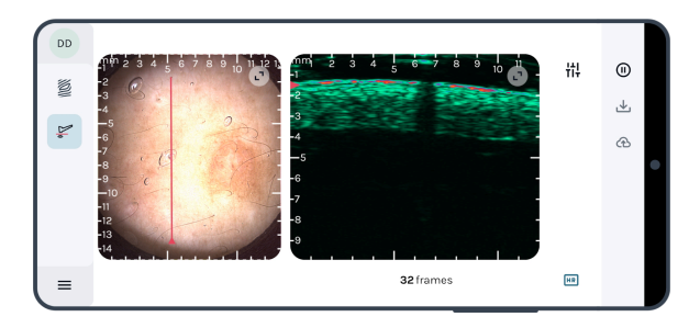 skin-imaging-dermus-skinscanner